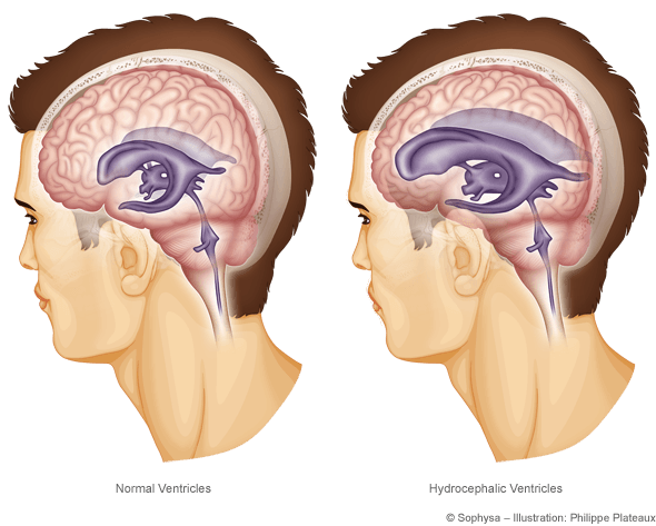 Adult hydrocephalus