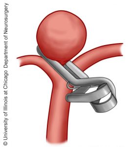 Aneurysm Clipping