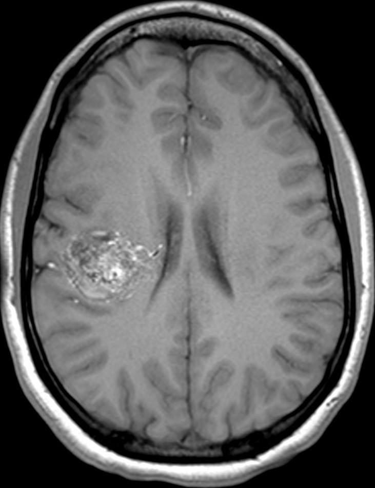 brain AVM scan