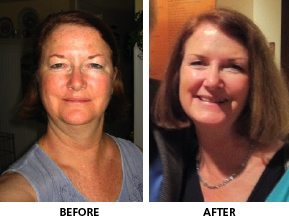 Cushing's disease patient before and after surgery