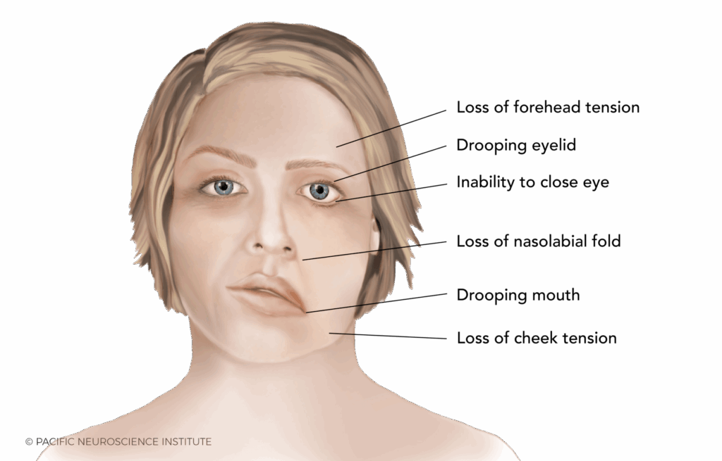 Ramsay Hunt Syndrome Illustration