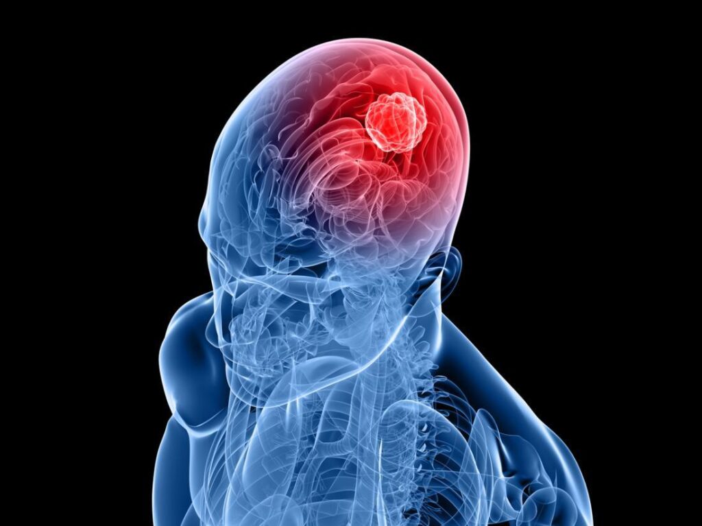 Brain tumor graphic