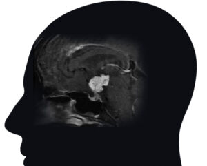 MRI of a Craniopharyngioma tumor.