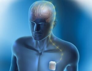 Deep Brain Stimulation (DBS)