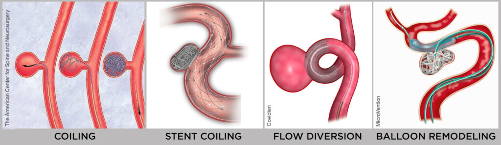 Endovascular Surgery