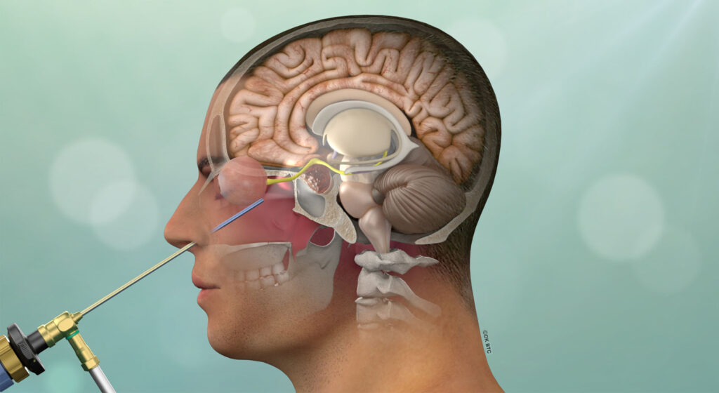 illustration of a pituitary procedure