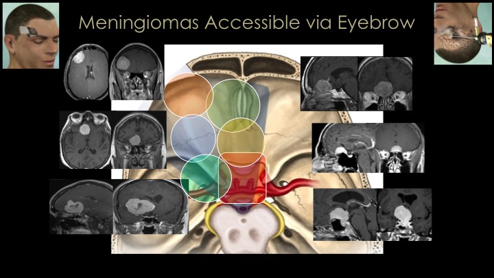 Keyhole Meningioma Surgery via eyebrow