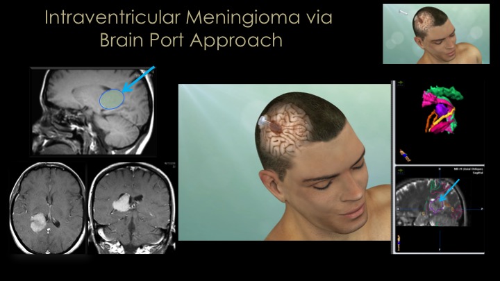 Keyhole Meningioma Surgery via brain port approach