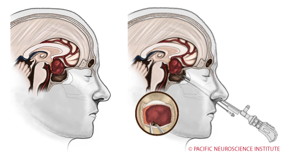 PNI Pituitary Medical Illustration