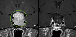 Pituitary adenoma pre and post surgery.