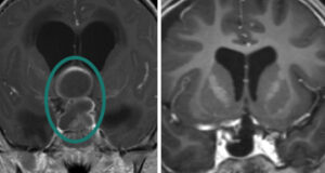 Craniopharyngioma pre and post-op MRI.