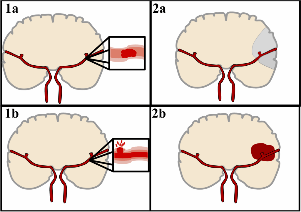 Ischemic (top), caused by a blood clot in an artery (1a) results in brain death in the affected area (2a). Hemorrhagic (bottom), caused by blood leaking into or around the brain from a ruptured blood vessel (1b) allows blood to pool in the affected area (2b), increasing the pressure on the brain. ElinorHunt, CC BY-SA 4.0 .