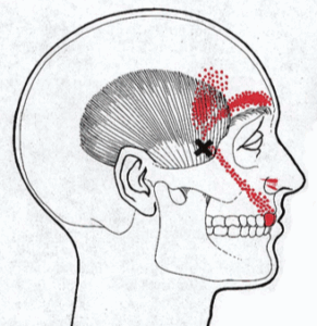 Temporalis Pain Referral Pattern