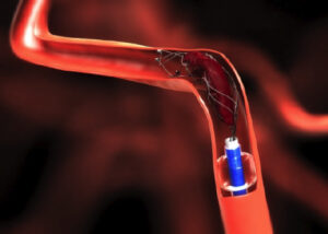 Thrombectomy after 6 hours of treatment.