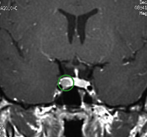 Tumor on Pituitary CD MRI