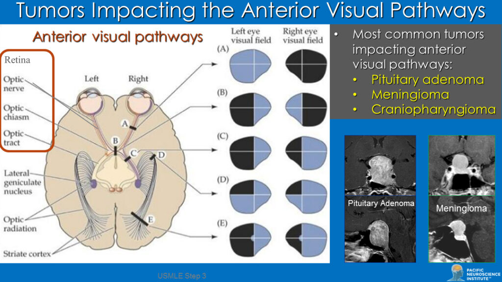 Tumors impacting vision