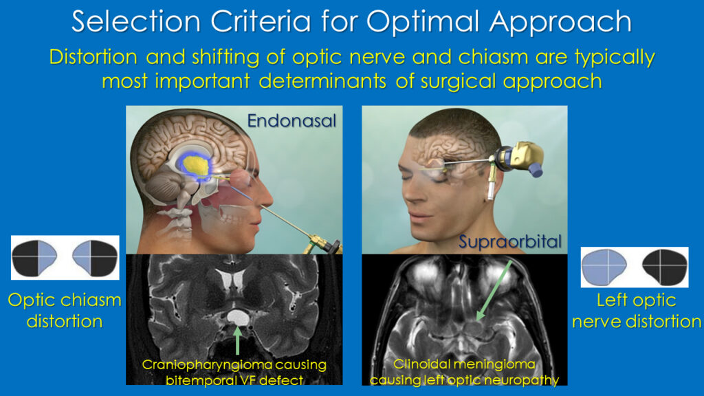 Tumors impacting vision