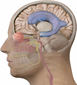 hydrocephalus