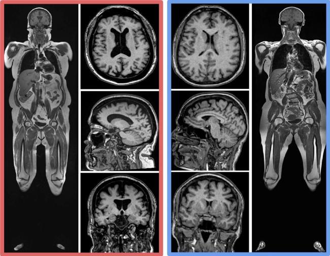 Examples of Higher Body Fat and Brain Volume Loss