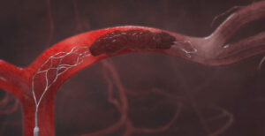 Stent Retriever | Source: Stryker Inc.