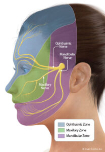 Trigeminal schwannoma zones.