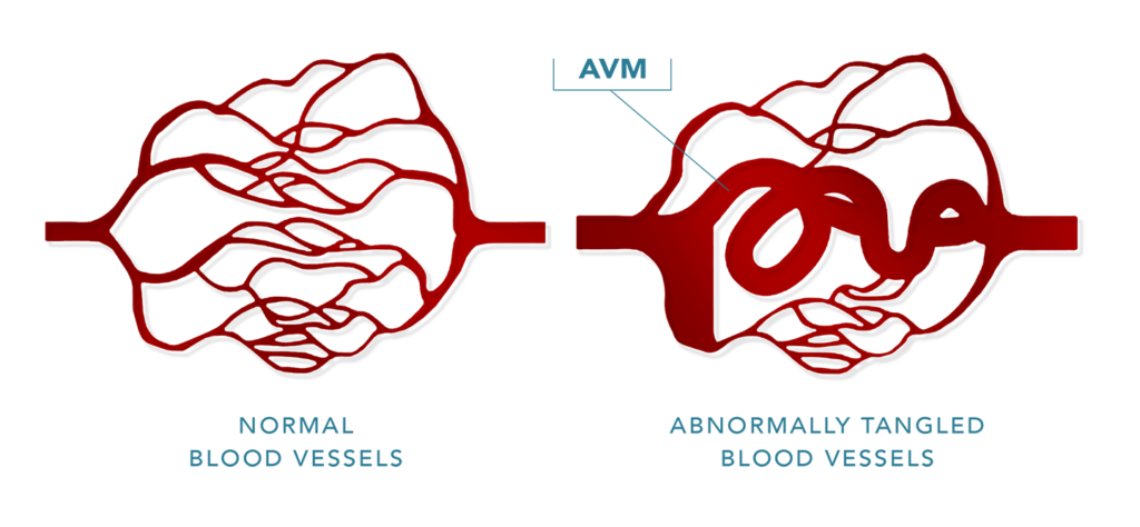 Arteriovenous Malformation (AVM)