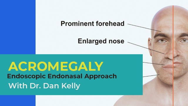 Acromegaly surgical approach