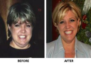Before & After Cushing's Disease Surgery 02