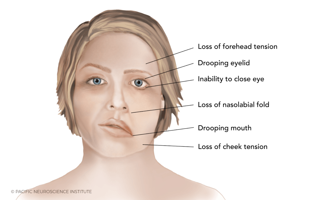 Ramsay Hunt Syndrome Explained By Dr Amit Kochhar Pacific