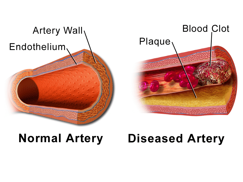 Blood clot illustration with diseased artery and normal artery