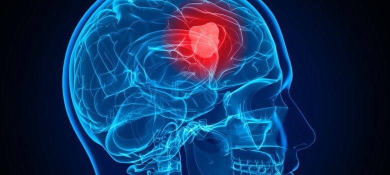 Brain Tumor Radiation Therapy IORT