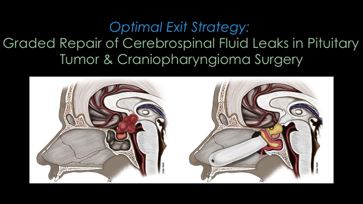 craniopharyngioma surgery