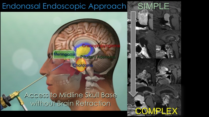 Endoscopic Endonasal Surgery diagram