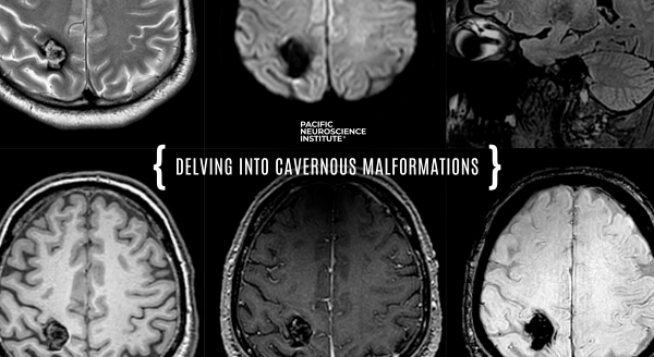 Cavernous Malformations