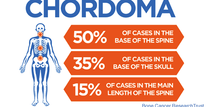 Chordoma infographic