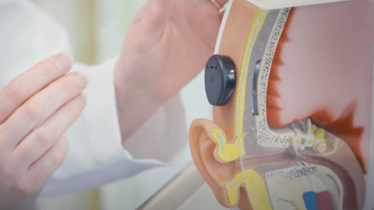 Cochlear Implant with Dr Rebecca Lewis thumbnail