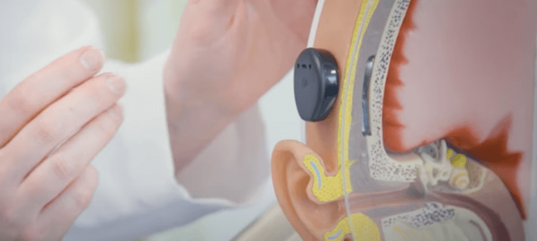 Cochlear Implant with Dr Rebecca Lewis thumbnail