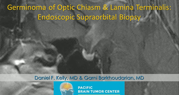 Endoscope Assisted Eyebrow Craniotomy for Germinoma