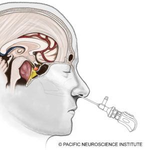 endoscopic-endonasal-clivus-chordoma