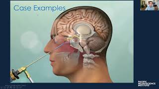 Pacific Neuroscience Institute Endoscopic Endonasal Surgery