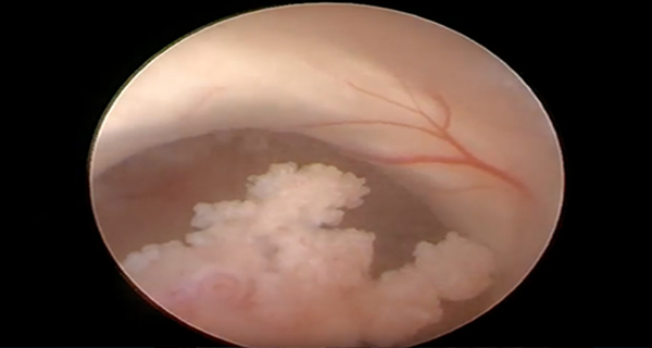 endoscopic view