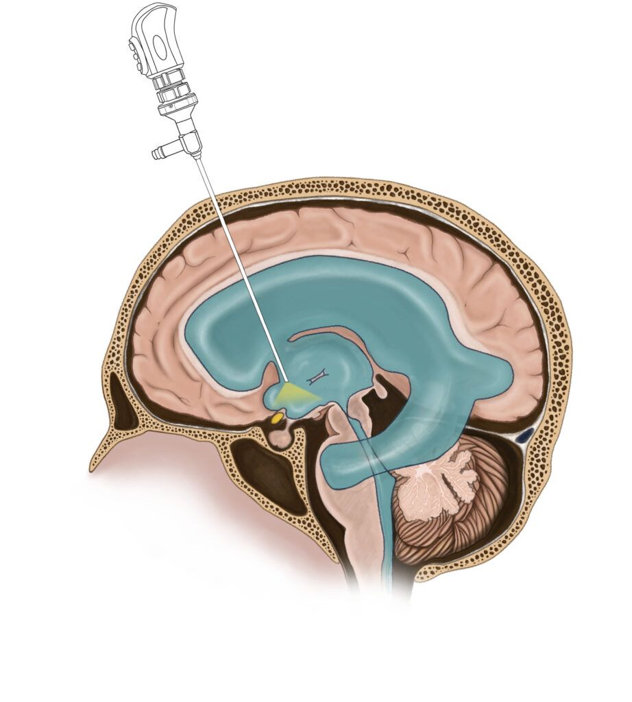 Hydrocephalus
