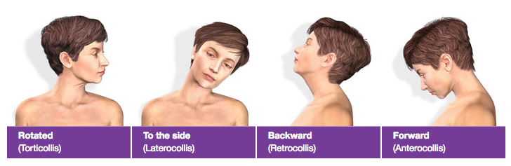 Dystonia head positions