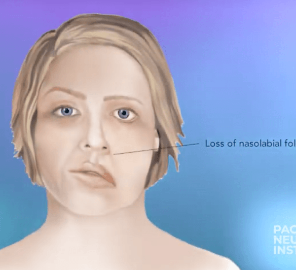 illustration of person with facial paralysis