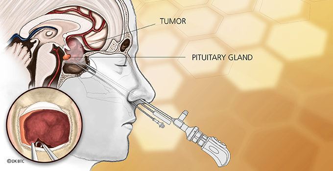 endonasal procedure illustration