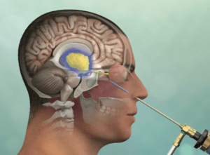 Pituitary Endonasal endoscopy