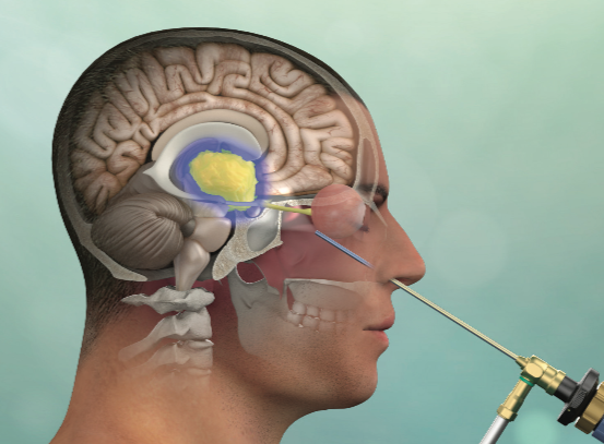 Pituitary Endonasal endoscopy illustration