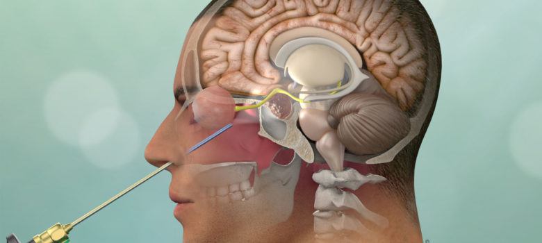 Endoscopic surgery for Cushing's disease