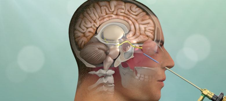 Illustration of a pituitary adenoma procedure