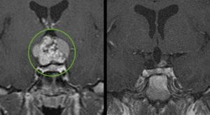 Craniopharyngioma tumor pre and post surgery.